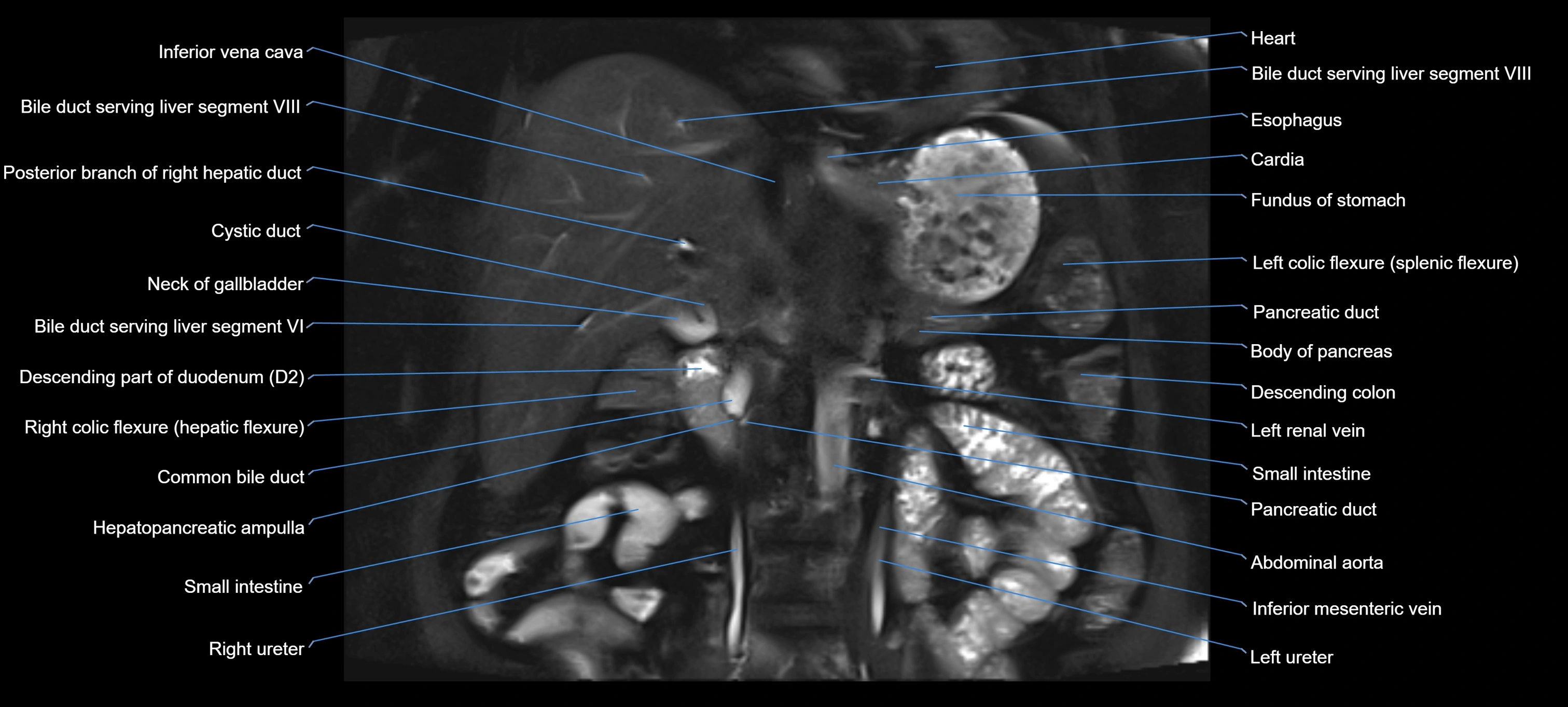 MRI MRCP coronal cross sectional 3T radiology  image-img-00001-00014.webp